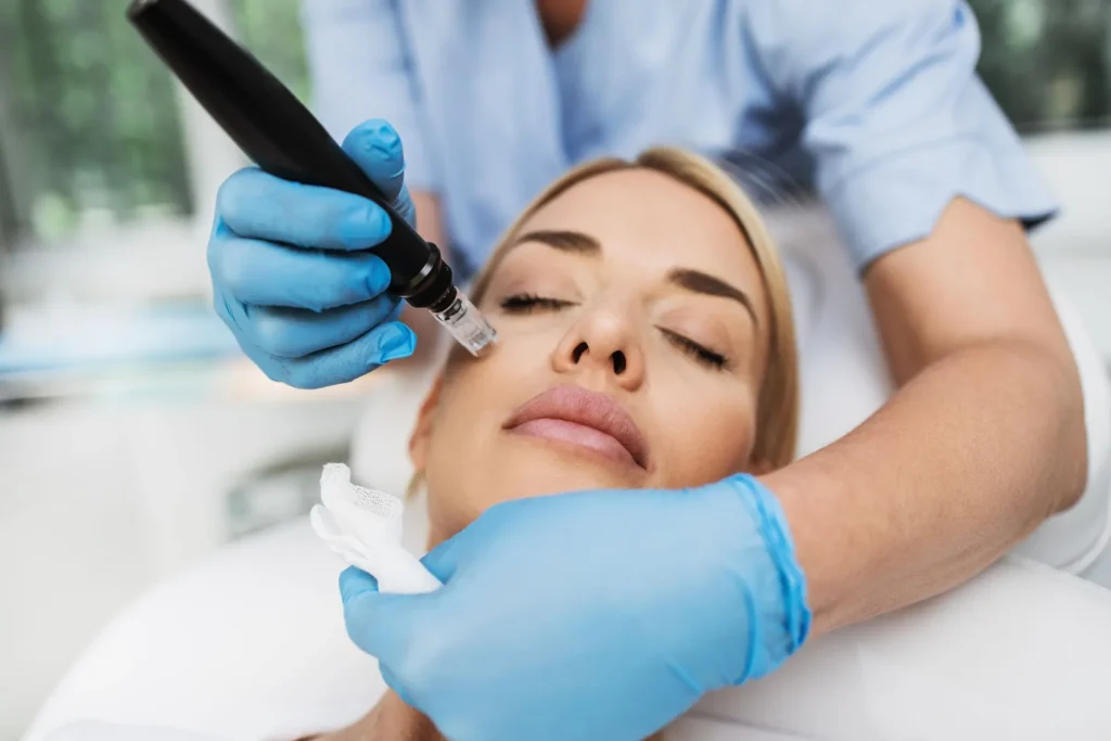 Woman receiving microneedling treatment on her face in a medical setting.